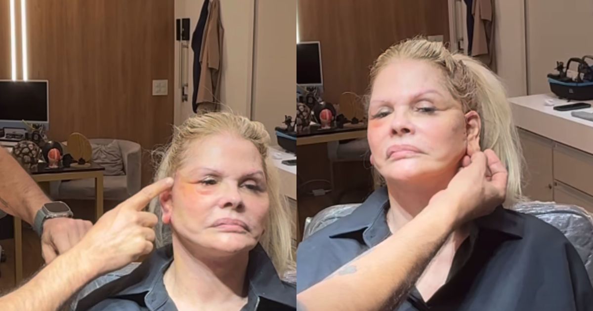 Monique Evans mostra resultado do rosto cinco dias após procedimento