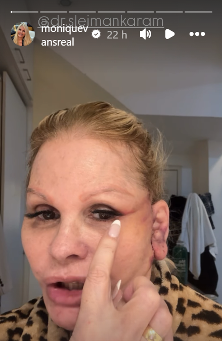 Monique Evans faz procedimento no rosto e revela que ficou "irreconhecível" • Reprodução/Instagram/Monique Evans