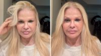 Monique Evans fica em choque com resultado de cirurgia plástica facial