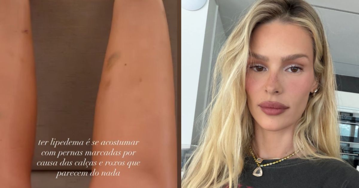 “Roxos aparecem do nada”: Yasmin Brunet mostra hematomas; entenda lipedema