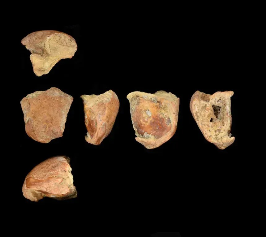 Um dos dentes do Neandertal, mostrado aqui em diferentes ângulos, estava rachado longitudinalmente, provavelmente devido a um traumatismo contundente na face • Emma Pomeroy