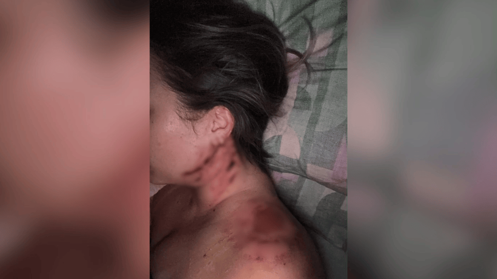 Mulher estava em ato para comemorar a vitório do presidente Lula quando foi atingida por um rojão