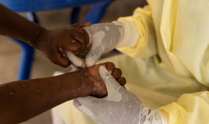 Agências da ONU se preocupam com propagação de mpox em campos de refugiados do Congo