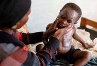 Resposta à mpox tem menos de 10% do financiamento necessário, diz centro africano