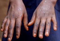 Índia confirma primeiro caso da cepa mais mortal da Mpox